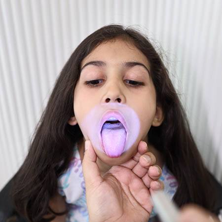 Tonsil Treatment for Kids Meerut